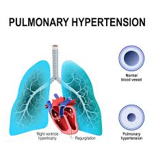 Image result for Hypertension