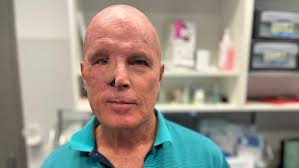 Wayne was 'very close' to losing his eye to skin cancer. His doctor urges  sun safety to be taken seriously