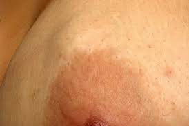 A rare and aggressive type of breast cancer where the cancer cells infiltrate the lymphovascular spaces within the skin dermis, causing changes in the overlying breast skin. Red Flag Symptoms Breast Lumps Gponline