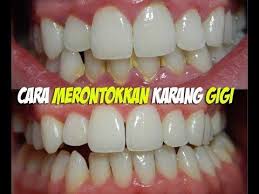Tips Cara Menghilangkan Karang Gigi Dengan Cepat Carakupedia Resep Langsing Diet Detoks Kesehatan