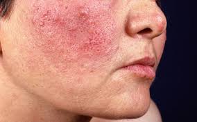 Rosacea ist eine entzündliche hautkrankheit, die sich hauptsächlich im gesicht zeigt. Rosacea Symptome Behandlung Pflege Tipps Onmeda De