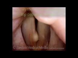 Mucus Retention Cyst Before And After Mucus Plug Mucus Cysts