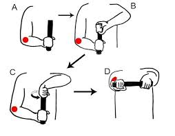 Treating Tennis Elbow With The Tyler Twist Fabrication