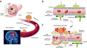 It can also cause mood. Understanding Patterns Of Brain Metastasis In Triple Negative Breast C Ott