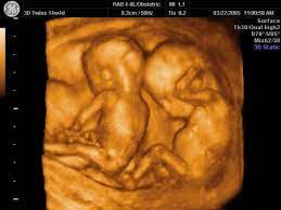 Barriga De Aluguer De Gemeos E Mae De Um Dos Bebes Pplware Kids