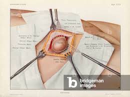 Image result for Enterostomy