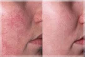 15€ discount for your first order ! Laser Couperose Rougeurs Angiomes Visage Nord Lille 59 Traitement Soin