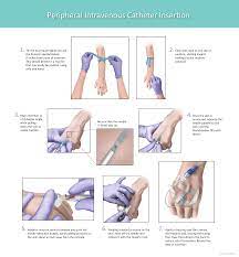 Peripheral Intravenous Catheters: A Review Of Guidelines ❤️ Best adult  photos at like2ch.com