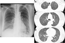 Image result for Pulmonary Intoxicant