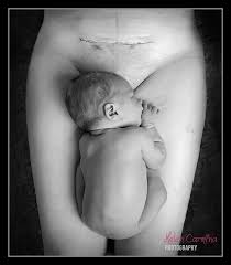 Use warm, soapy water to wash your incision daily (usually when you shower). 10 Powerful Photos Of Moms Showing Off Their C Section Scars