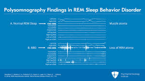 Image result for REM Sleep Behavior Disorder