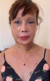 Hlv phạm minh đức của hà tĩnh không hài lòng về cách điều hành của tổ trọng tài bắt trận đấu trên sân thống. Co Dau 62 Tuá»•i Gay Báº¥t Ngá» Vá»›i Diá»‡n Máº¡o Má»›i Sau Thá»i Gian Váº­t Ly Trá»‹ Liá»‡u Vi Biáº¿n Chá»©ng Pháº«u Thuáº­t Saostar