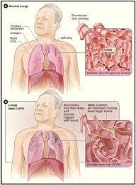 Emphysema and chronic bronchitis are two types of copd, or chronic obstructive pulmonary disease. Researchers Publish Largest Study Linking Occupational Cleaning Products Exposure And Copd