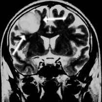 Klinik Und Poliklinik Fuer Neurochirurgie Gliome