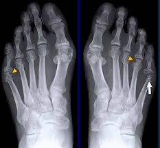 Image result for XRay Changes in Rheumatic Conditions