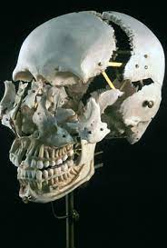 Anatomicdeadspace Cranium With The Bones Of The Calvarium And Face And Mounted Separately By Bauchene S Method This Method Of Di Human Skull Skull Art Skull