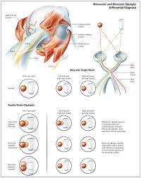 Image result for Diplopia