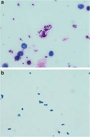 May 26, 2018 · gram positive cocci in clusters is easy for medical lab technologist to identify the appearance and arrangement of gram positive cocci. Validation Of Blood Culture Gram Staining For The Detection Of Staphylococcus Aureus By The Oozing Sign Surrounding Clustered Gram Positive Cocci A Prospective Observational Study Springerlink
