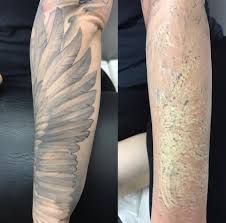 During your tattoo consultation, a reputable professional will discuss issues such to see the best results with tattoo removal, follow your medical practitioner's advice. Immediately Results After One Session Wicked Laser Tattoo Removal Clinic ÙÙŠØ³Ø¨ÙˆÙƒ