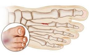 Stress fractures occur in bones that undergo mechanical fatigue. Stress Fracture Foot Problems