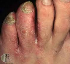 Image result for flegmona pedis)