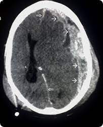 Como Se Diagnostica El Sindrome Sacudido Del Bebe