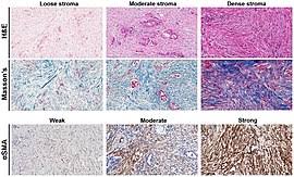 Desmoplasia Wikipedia