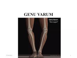 Image result for Genu Varum
