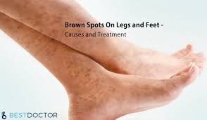 Image result for Pigment stains on the shin