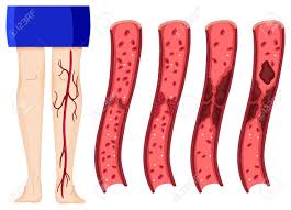 Cuando esto sucede en las venas profundas de la pierna, se llama trombosis venosa profunda (tvp). Coagulo De Sangre En Las Piernas Ilustracion Humana Una Trombosis Venosa Profunda Ilustraciones Vectoriales Clip Art Vectorizado Libre De Derechos Image 59309523
