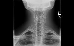 Here's what to expect with this painless procedure and why your dentist may recommend it. Cervical Spine Trauma Evaluation Spine Orthobullets