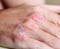 É uma doença não contagiosa, crônica e inflamatória da pele que se caracteriza por manchas cobertas de escamas e por prurido variável, por isso se diz que é uma doença eritematosa. Dia Mundial Da Psoriase A Pele Unindo Historias Barbacenamais Noticias De Barbacena E Regiao