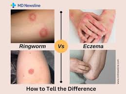 Image result for ringworm