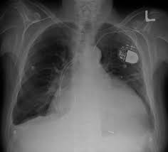Chest X Ray Interpretation A Structured Approach Radiology Osce