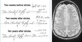 In offline settings handwriting stroke extraction is complicated by adjacent and overlapping strokes. The Telltale Hand Dana Foundation