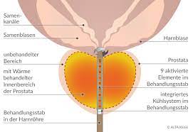 Diese beschwerde tritt gehäuft bei erwachsenen. Prostatavergrosserung Symptome Behandlung Therapie Alta Klinik