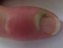 Image result for paronychium