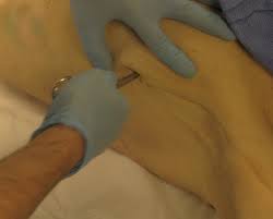 Image result for Small Caliber Chest Tube