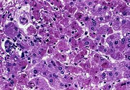 Marburg virus is a hemorrhagic fever virus of the filoviridae family of viruses and a member of the species marburg marburgvirus, genus marburgvirus. Marburg Virus Disease Wikiwand