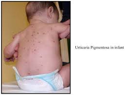 Image result for Urticaria pigmentosa children