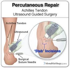 Achilles Tendon Surgery And Post Operative Rehabilitation Achilles Tendonitis Surgery Medical Stitches
