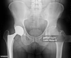 Image result for Hip XRay
