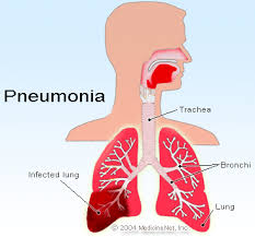 Read about pneumonia, including symptoms, causes, who's at risk, treatment and possible complications. Pneumonia Covid 19 Symptoms Causes Treatment