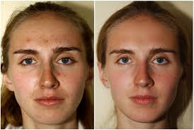 Villani Treatment™ — VILLANI MEDICAL