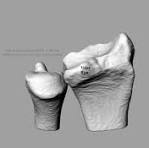 Distal Radius Fractures Involving The Volar Rim ...
