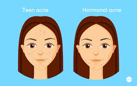 Hormonal acne tends to present with deep cysts underneath the skin and red, painful papules and pustules on the lower face. Hormonal Acne Best Treatment According To Dermatologists Mdacne