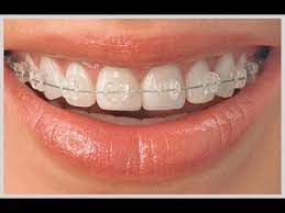 Check spelling or type a new query. How To Put Ceramic Braces On Teeth Dentalkart Youtube