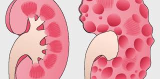 Polycystic Kidney Disease Treatment Adult Pediatric Urology