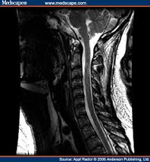 Multiple Sclerosis Ms Of The Spinal Cord Spinal Cord Multiple Sclerosis Magnetic Resonance Imaging