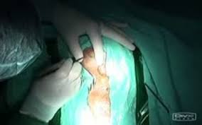 Hydrocephalus V P Shunt Surgery Video Neurosurgery Video